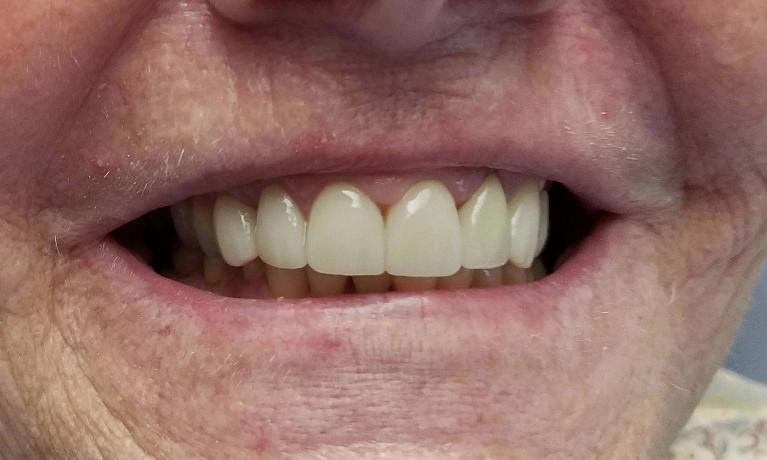 Porcelain-Crowns-After-Image