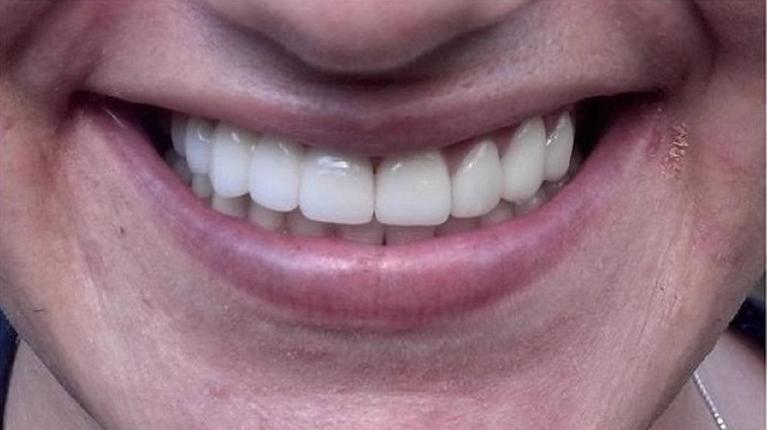 Replacement-of-old-crowns-and-bridges-After-Image