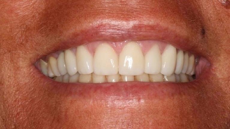Veneers-After-Image