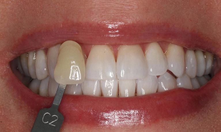 In-Office-Teeth-Whitening-After-Image