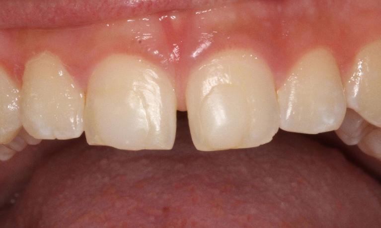Bonding-Before-Image