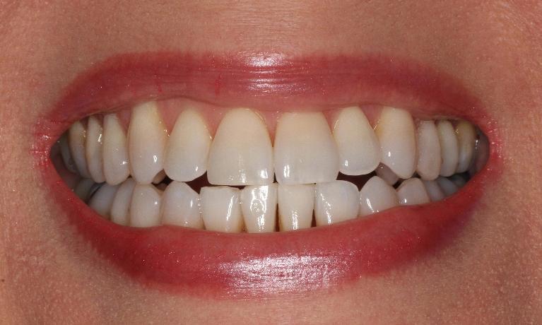 In-Office-Teeth-Whitening-Before-Image