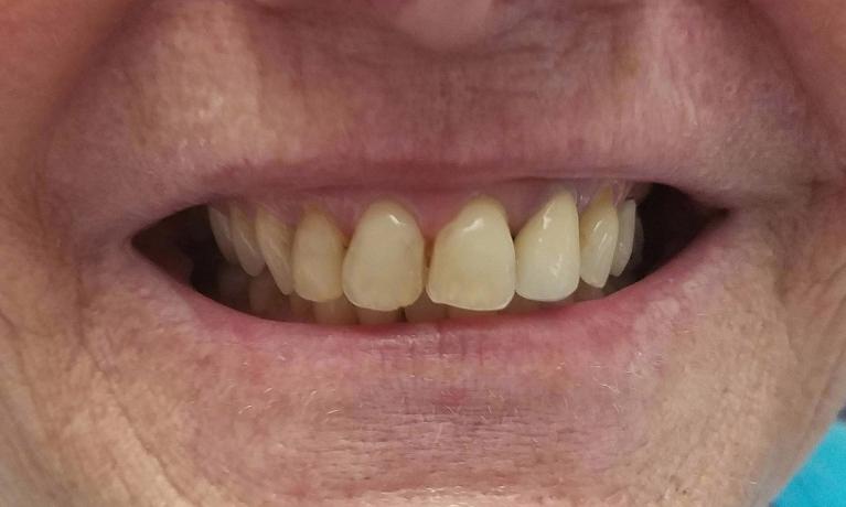 Porcelain-Crowns-Before-Image