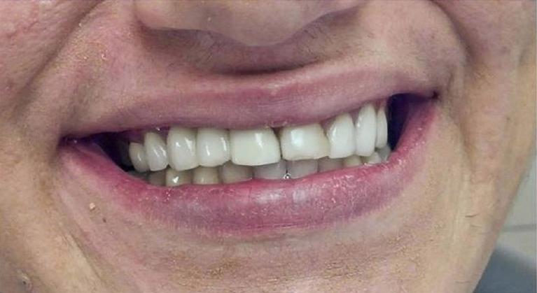 Replacement-of-old-crowns-and-bridges-Before-Image