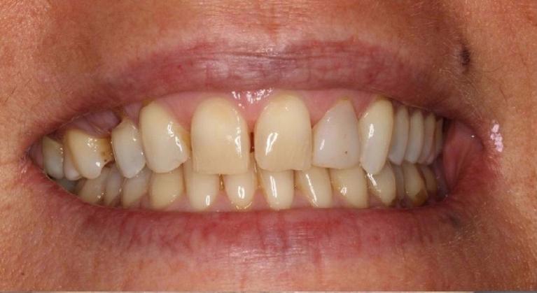 Veneers-Before-Image